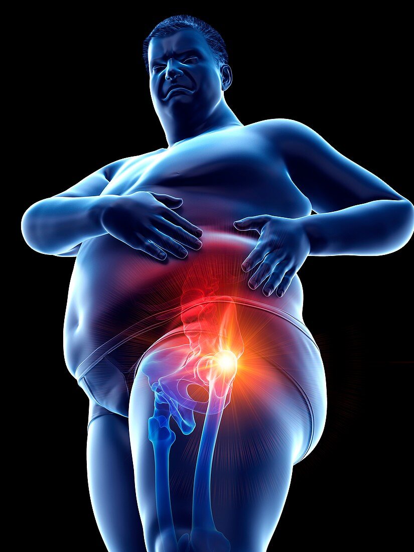 Obese man with hip pain, illustration