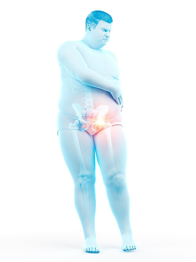 Obese man with hip pain, illustration