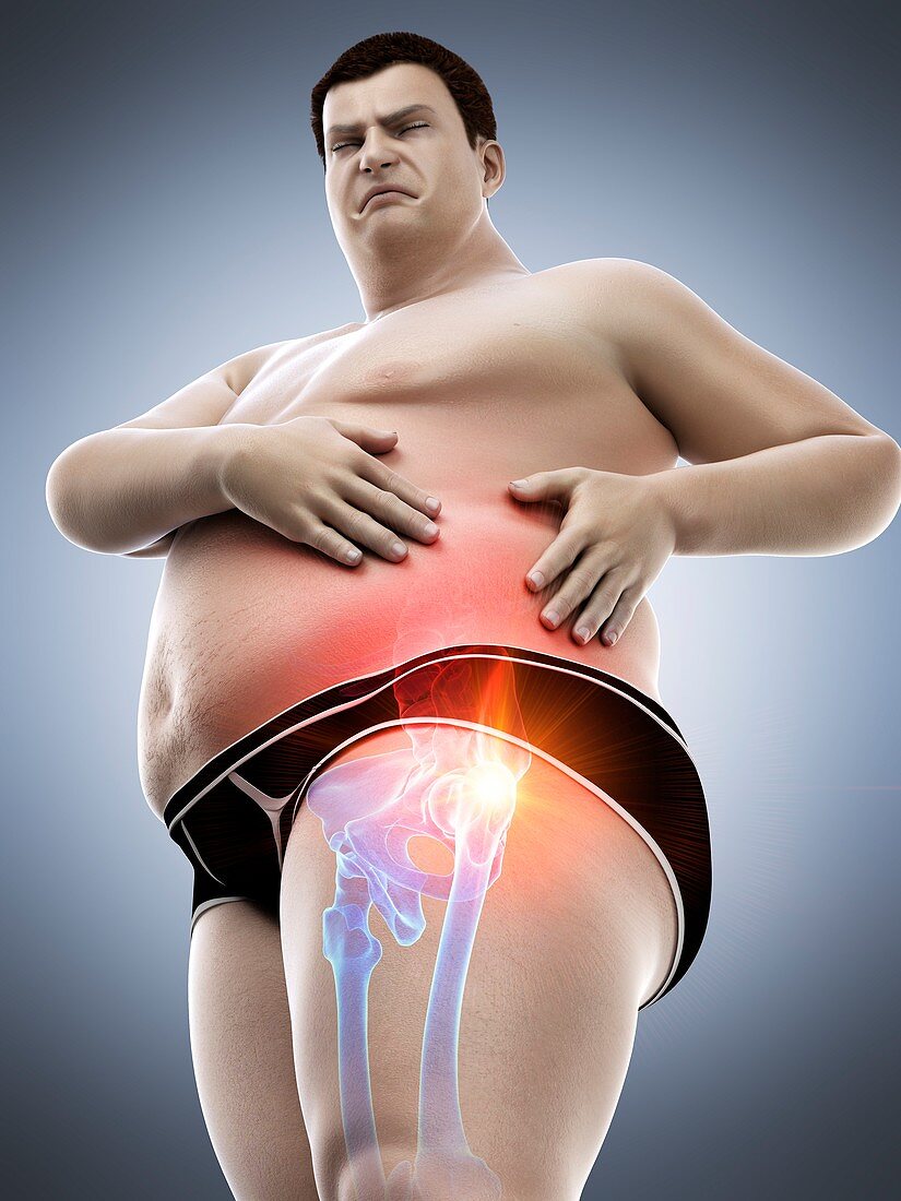 Obese man with hip pain, illustration