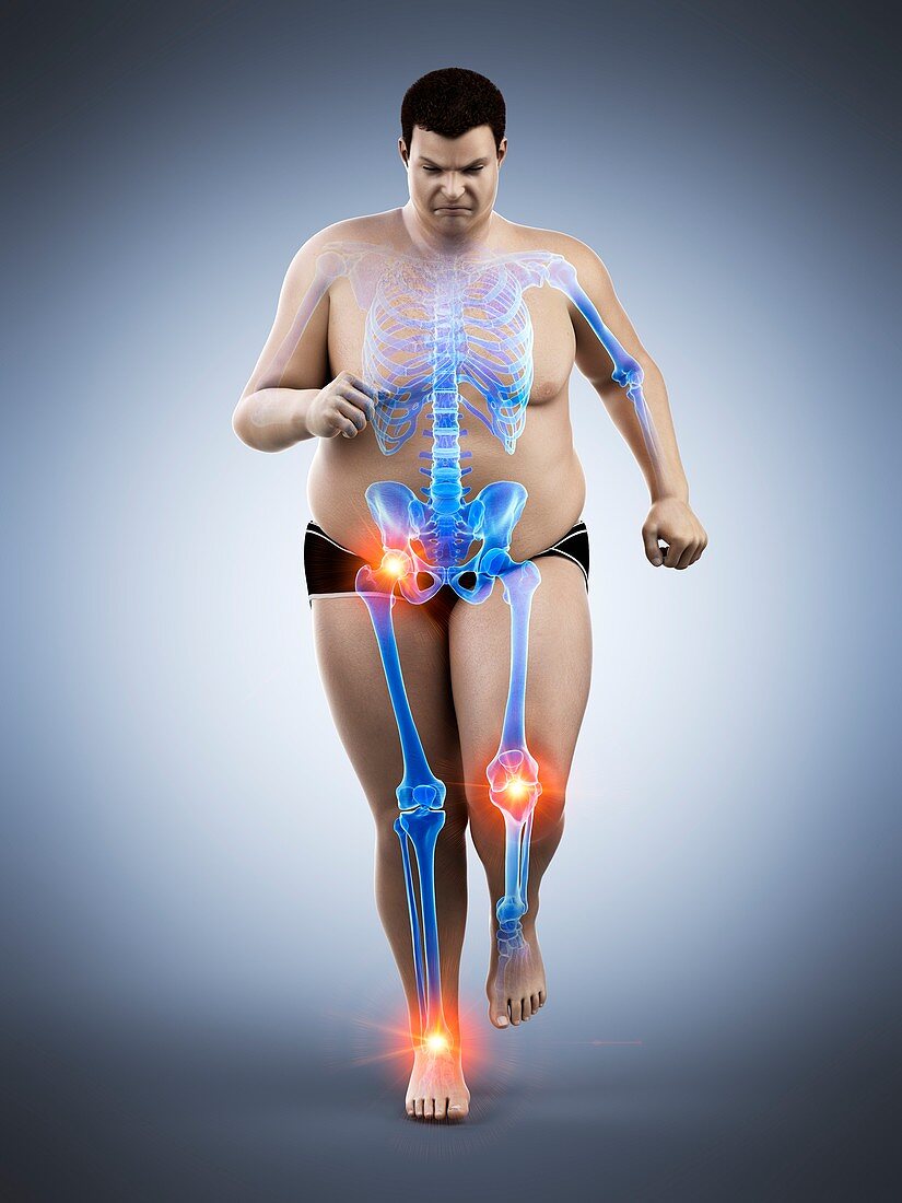Obese runner with joint pain, illustration