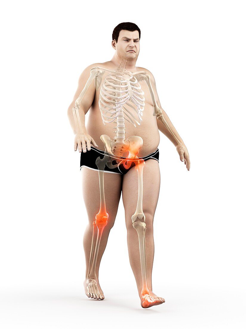 Obese runner with joint pain, illustration