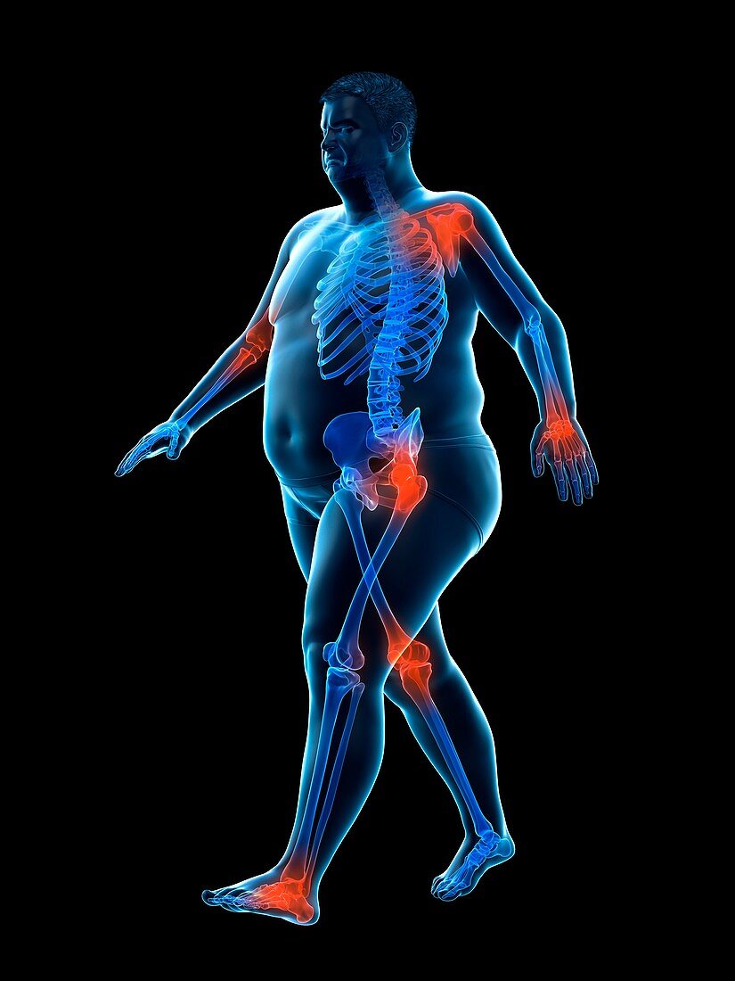 Obese runner with joint pain, illustration