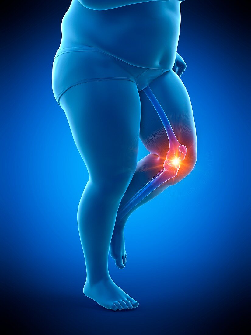 Obese runner with knee pain, illustration