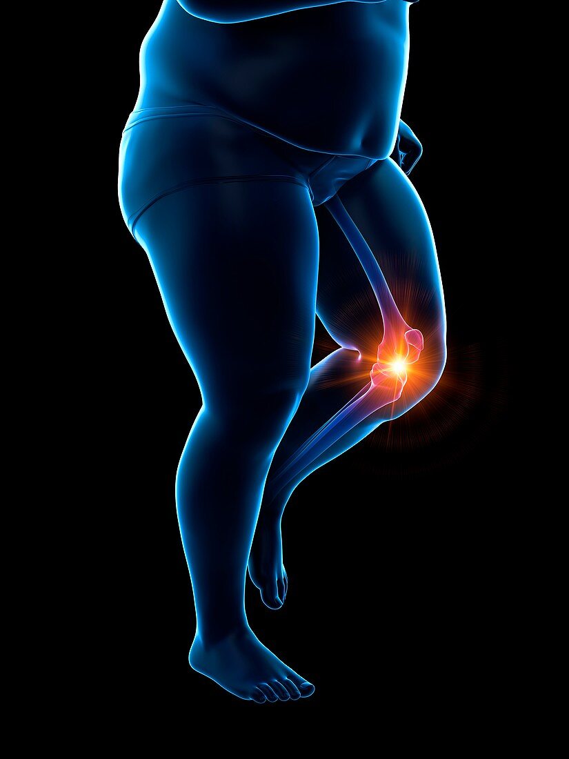 Obese runner with knee pain, illustration