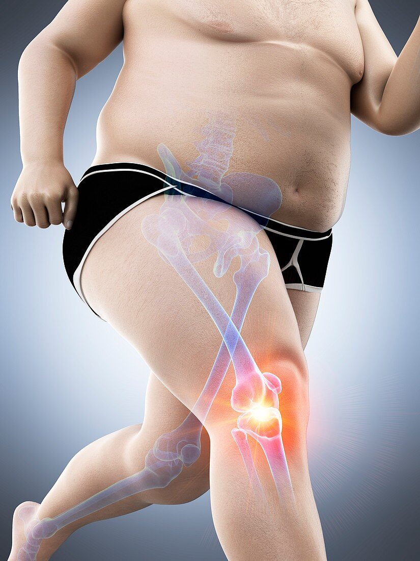 Obese runner with knee pain, illustration