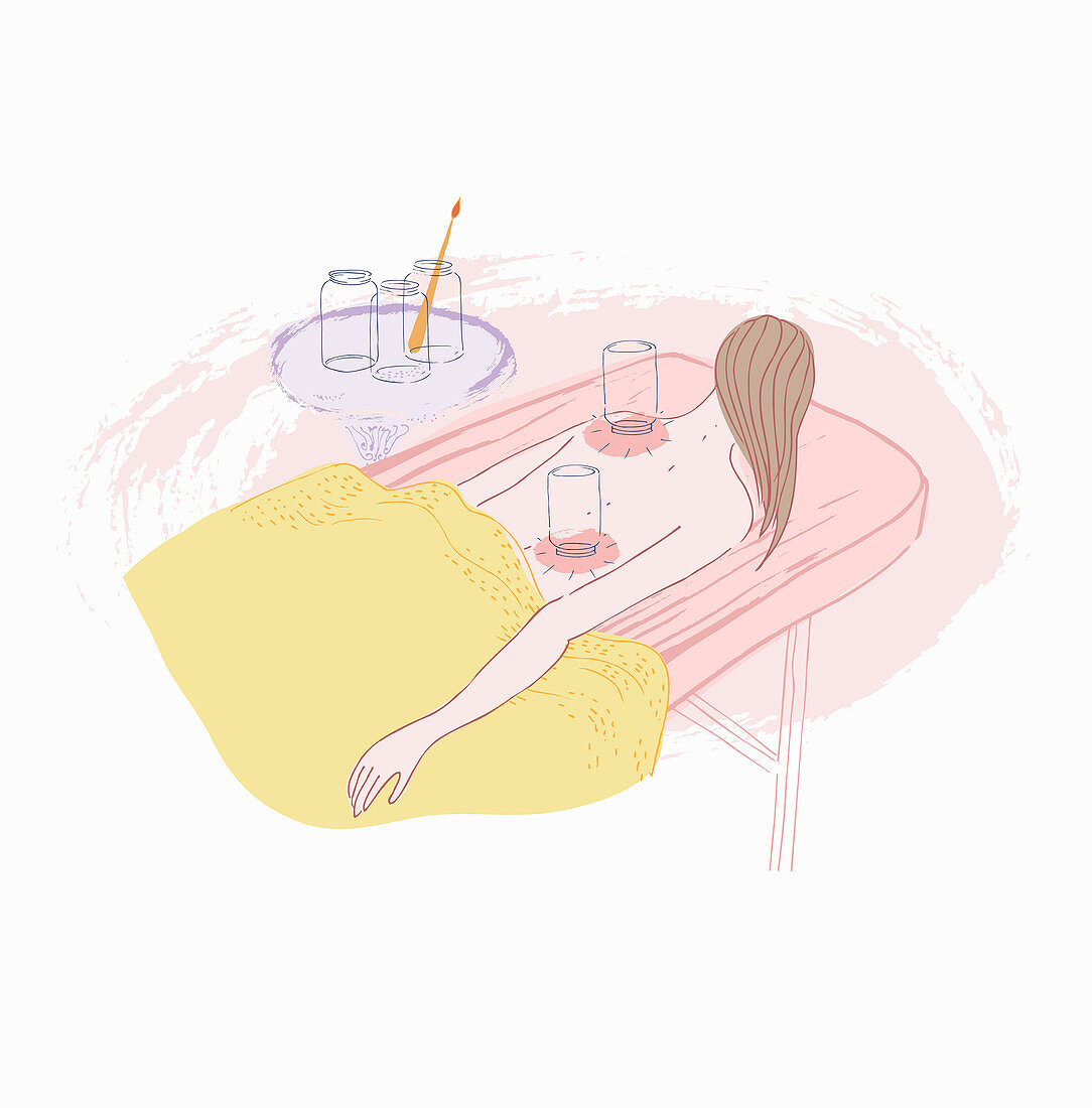 Cupping therapy, illustration