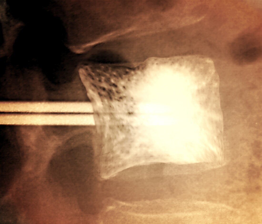 Vertebral augmentation in metastatic cancer, X-ray