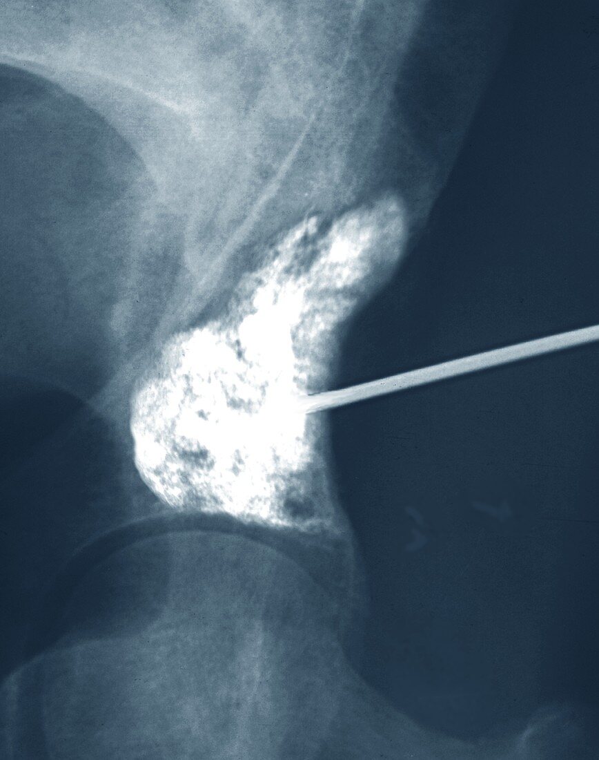 Bone augmentation in metastatic cancer, X-ray