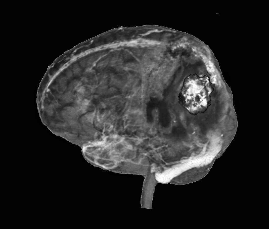 Brain tumour, MRI