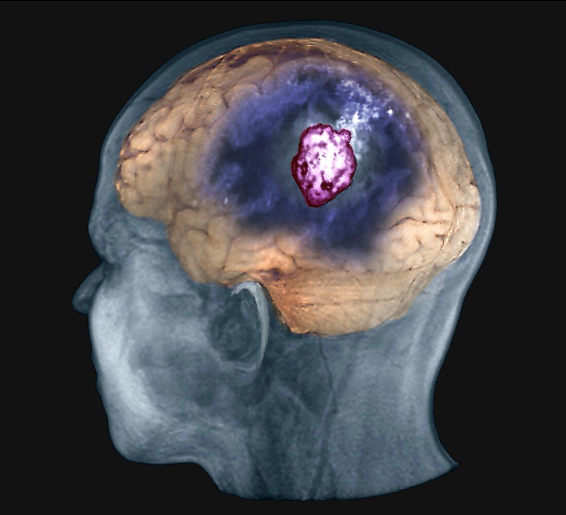 Brain tumour, 3D MRI