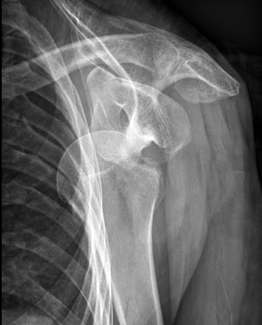 Dislocated shoulder, X-ray