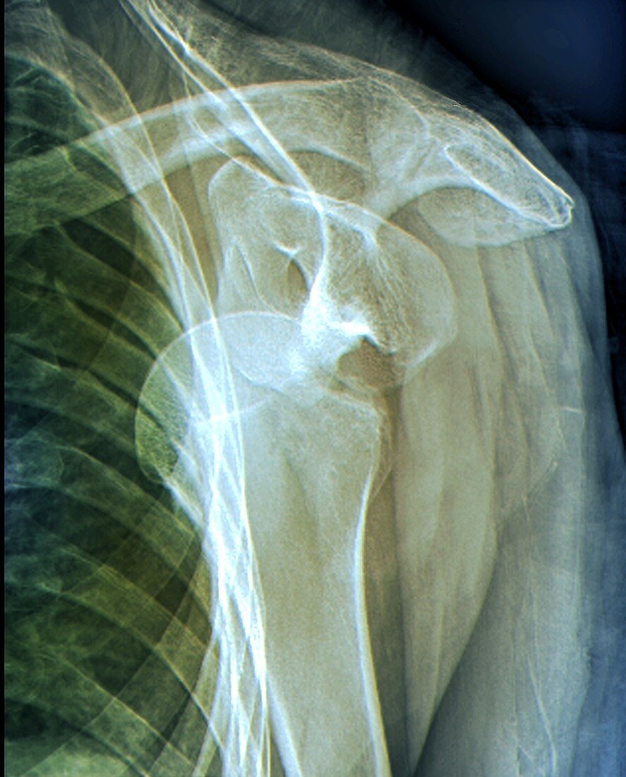 Dislocated shoulder, X-ray