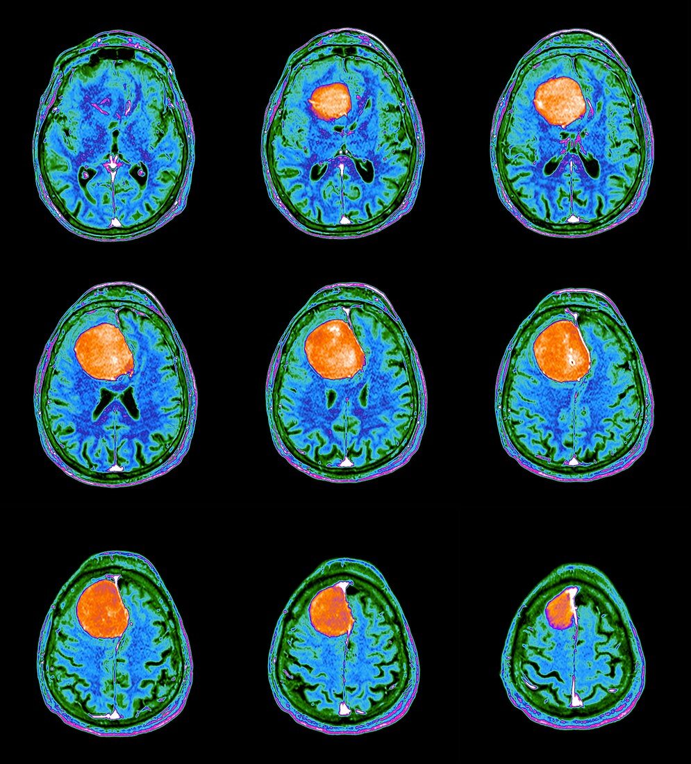 Meningioma brain tumour, MRI