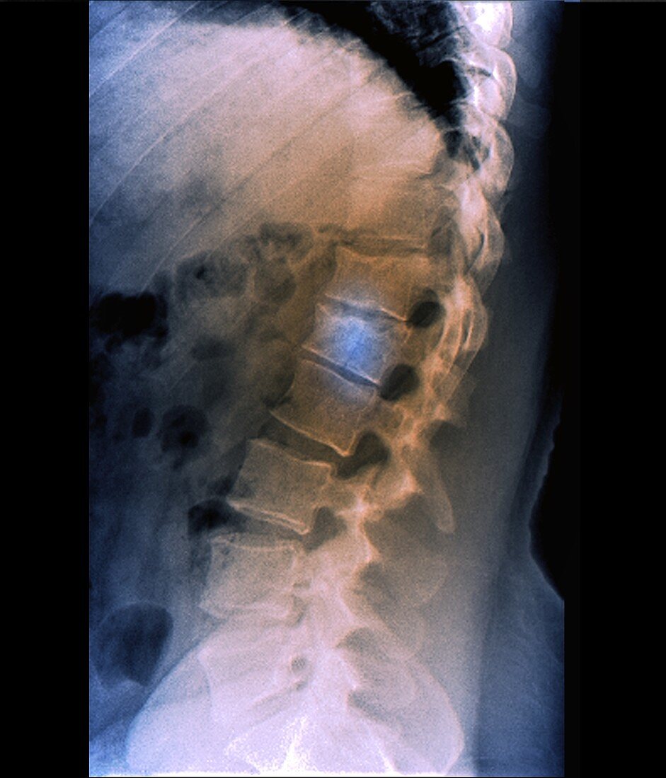 Spinal fracture, X-ray
