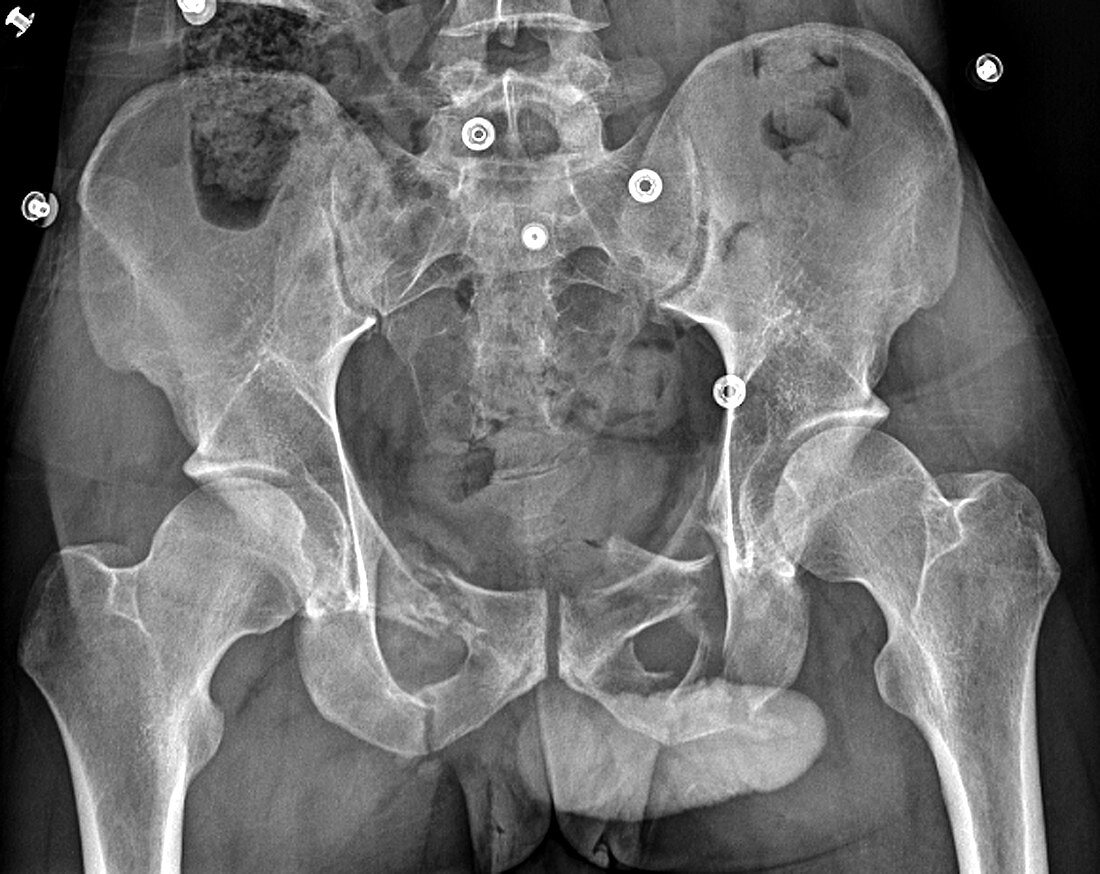 Pelvic fracture, X-ray