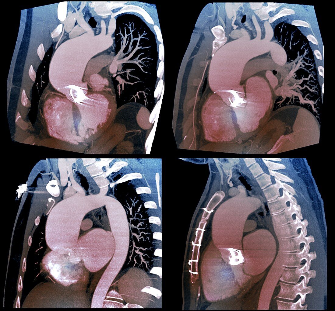 Thoracic aortic aneurysm, CTA scans