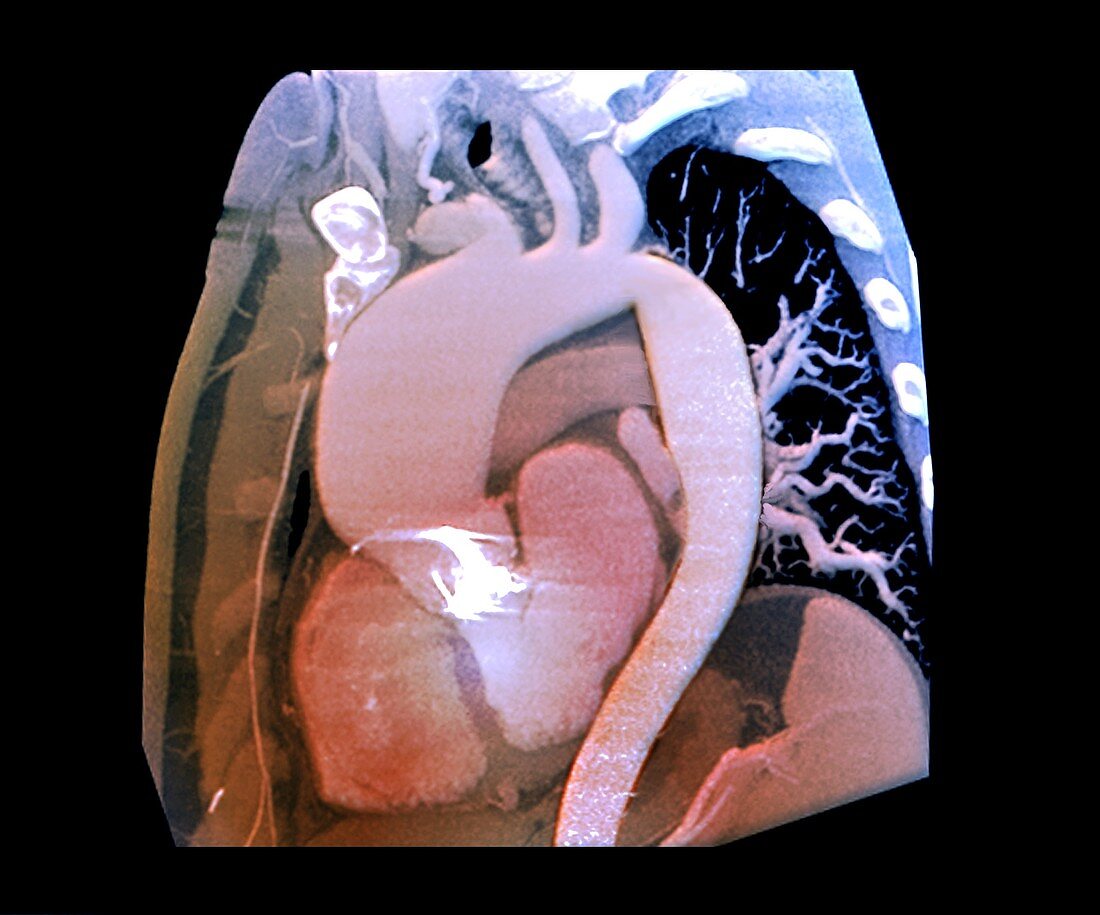 Thoracic aortic aneurysm, CTA scan