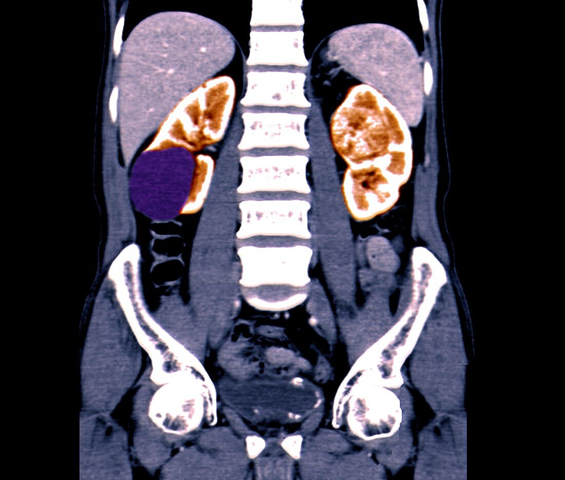 Renal cancer, CT scan