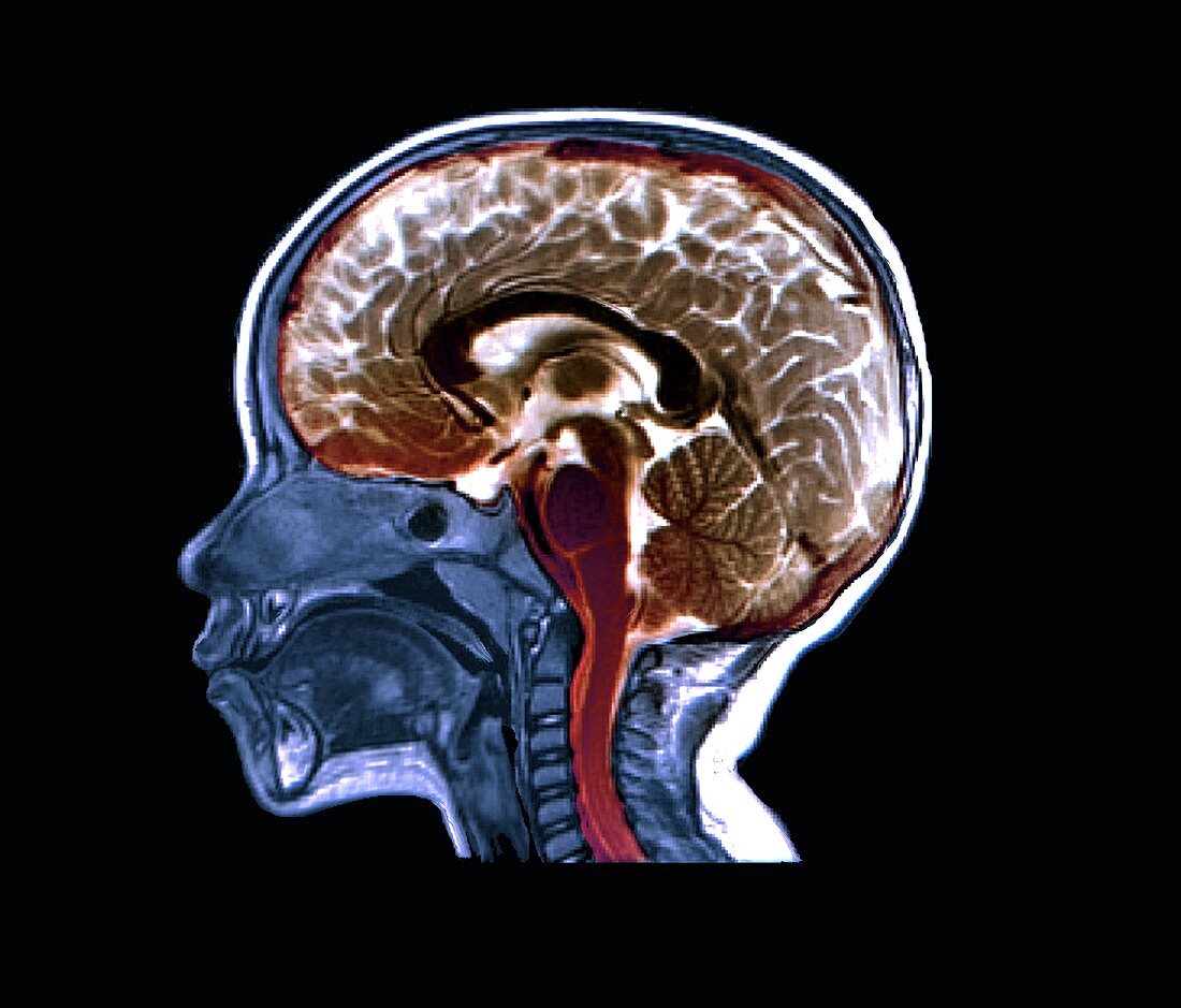 Child's head and brain, MRI scan