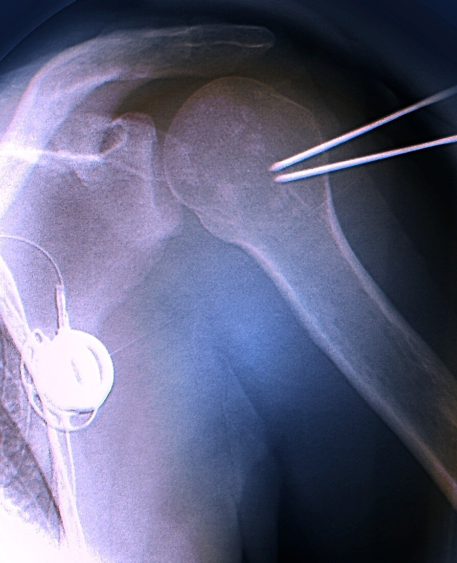 Shoulder cementoplasty, X-ray