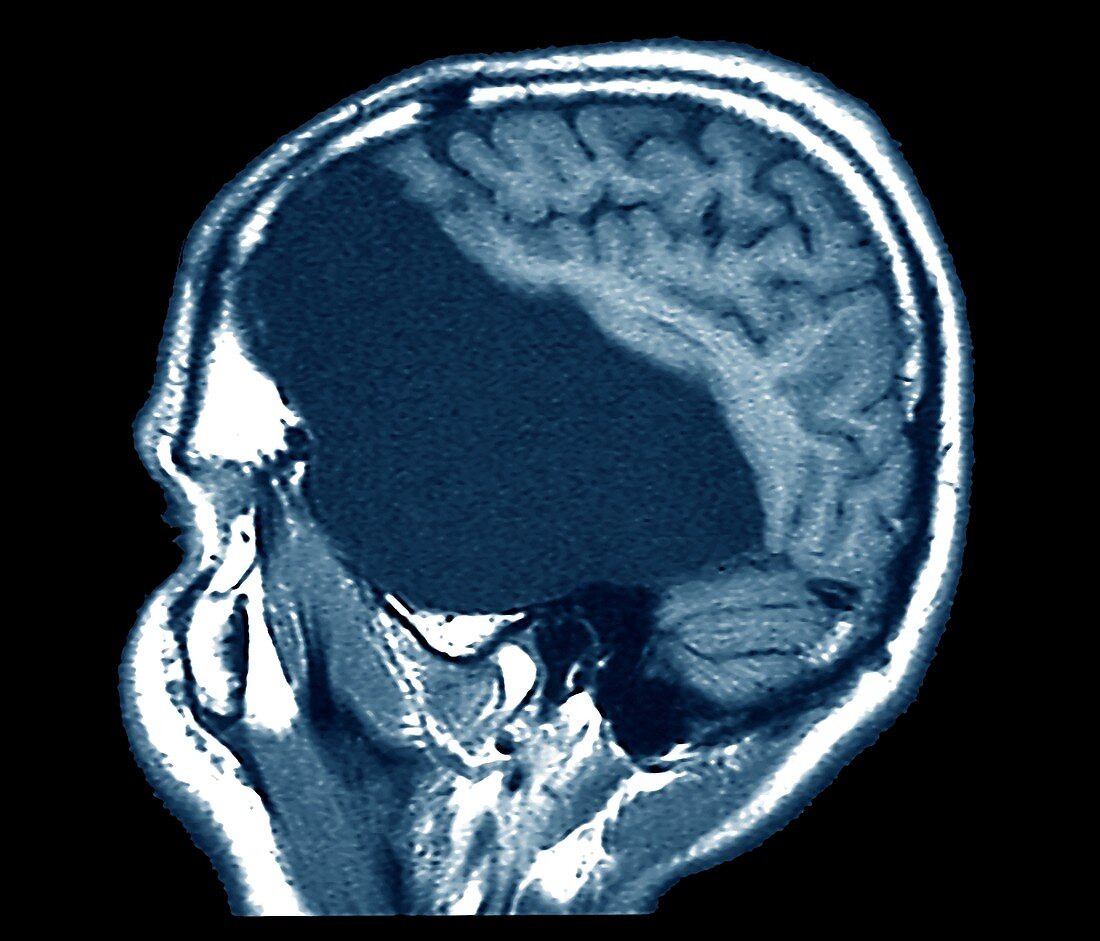 Large arachnoid cyst, MRI scan