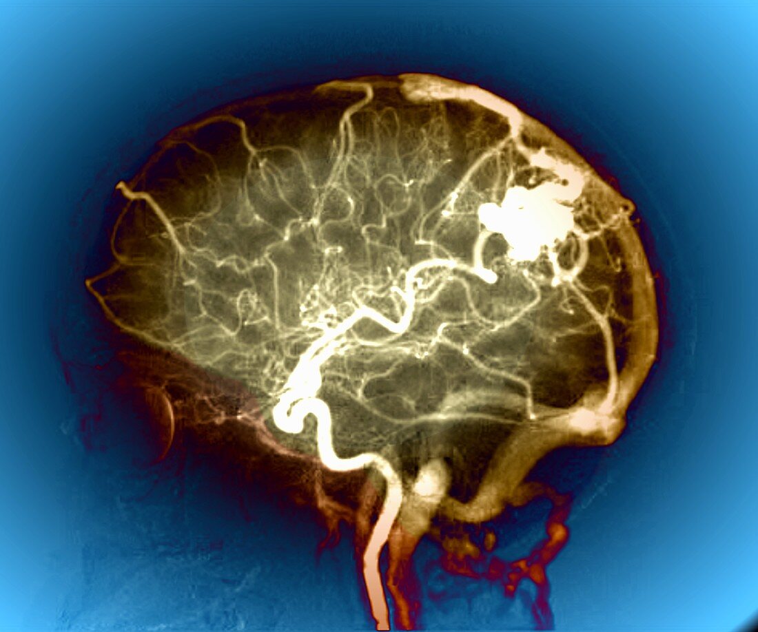 Cerebral arteriovenous malformation, X-ray