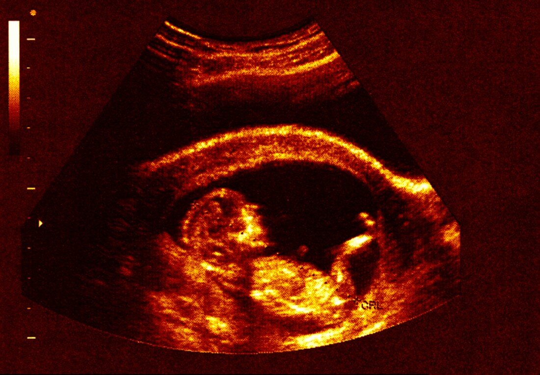 Foetus at 12 weeks, ultrasound scan
