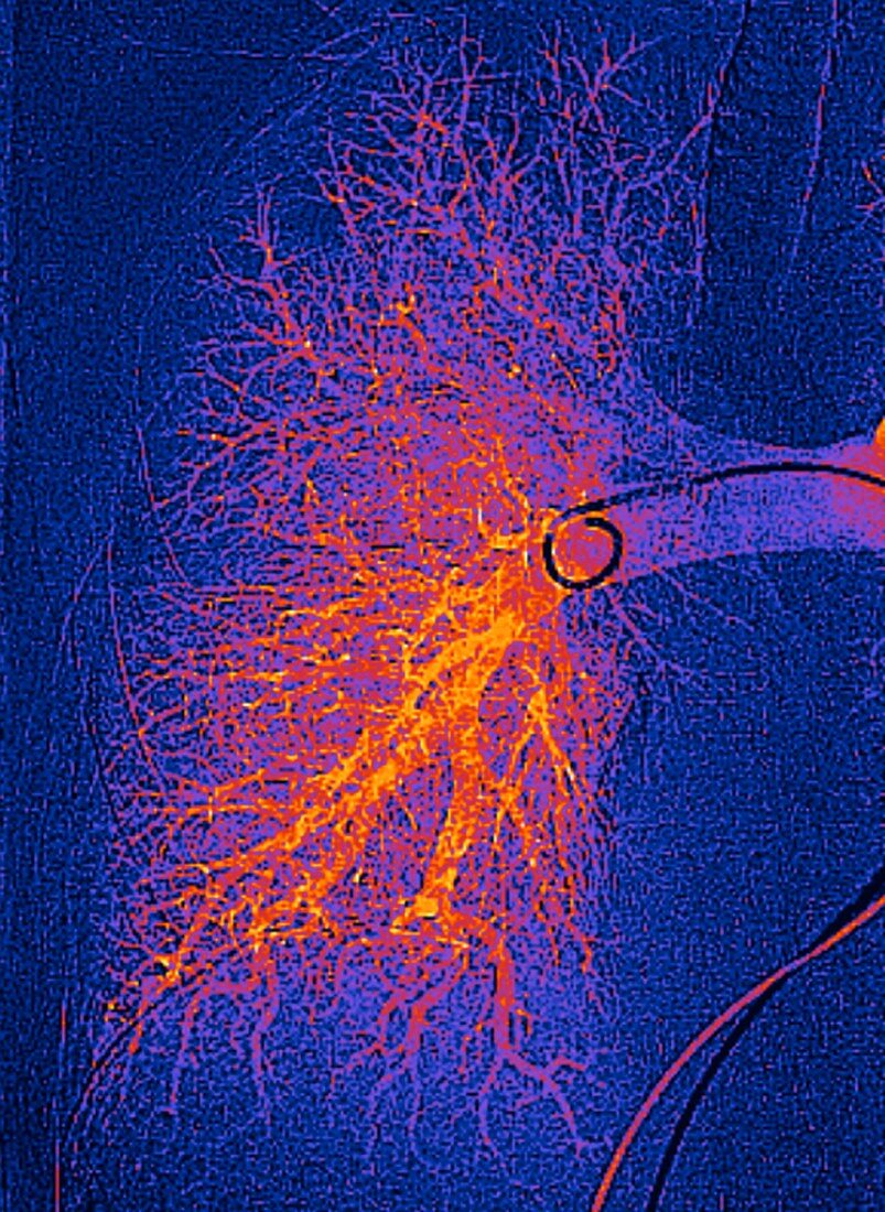 Lung blood vessels, angiogram