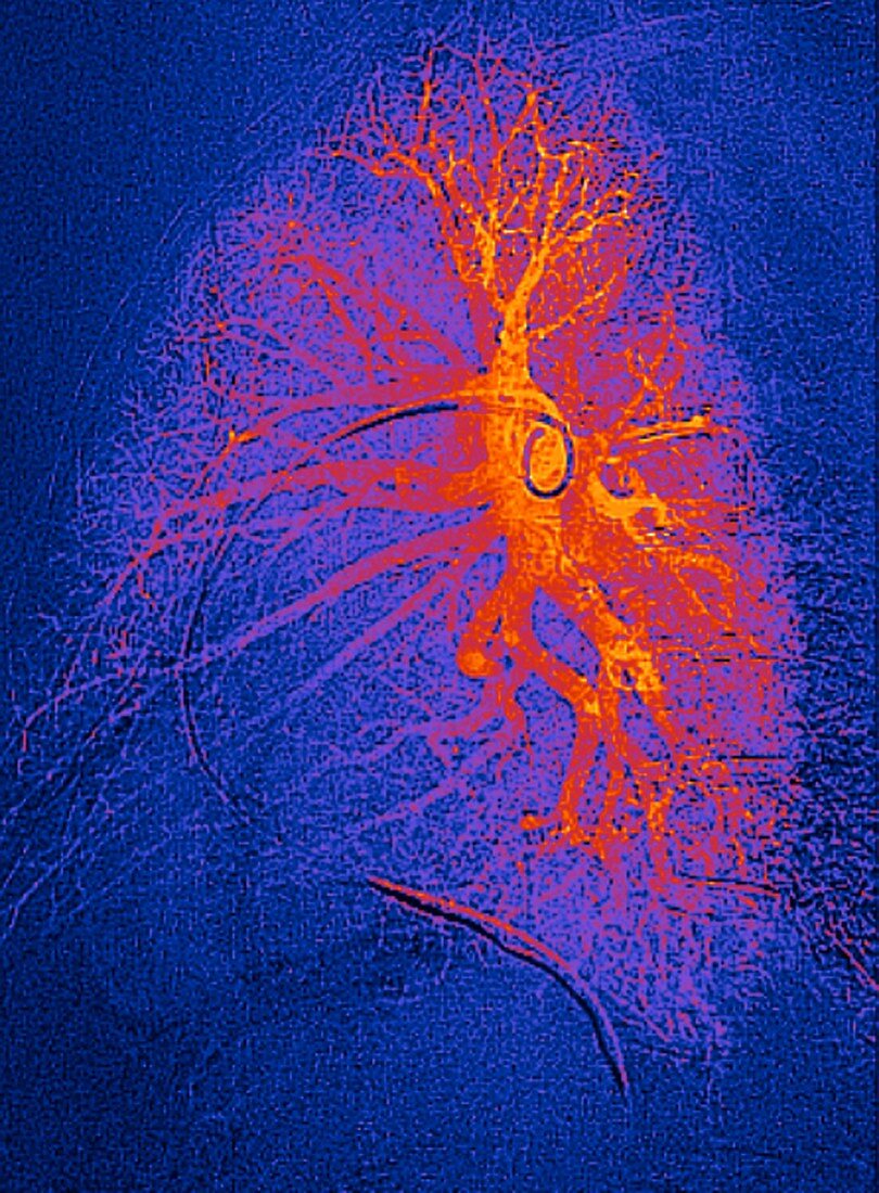 Lung blood vessels, angiogram