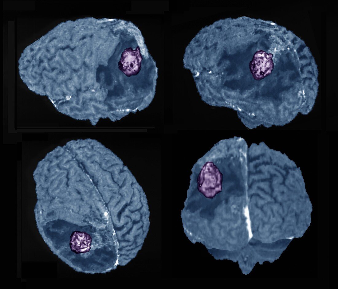 Recurrent glioma brain tumour, 3D MRI scans