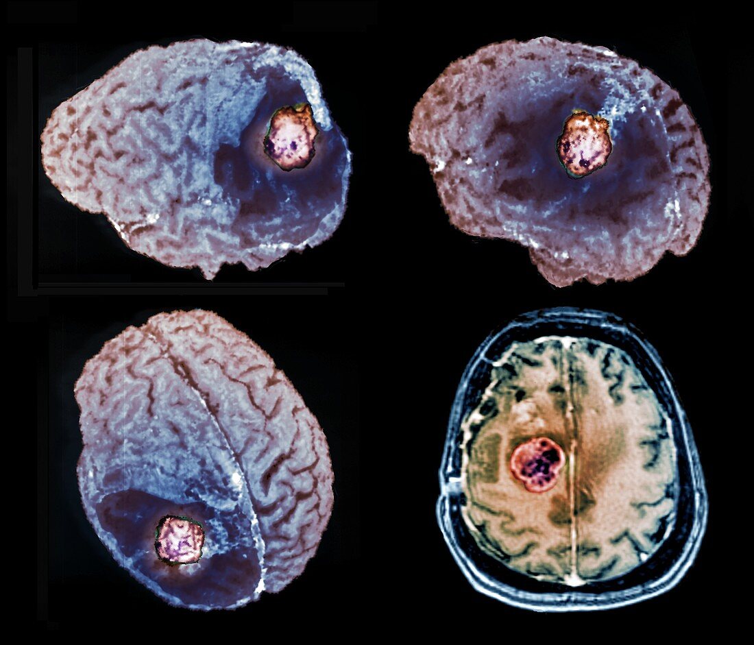 Recurrent glioma brain tumour, 3D and 2D MRI scans