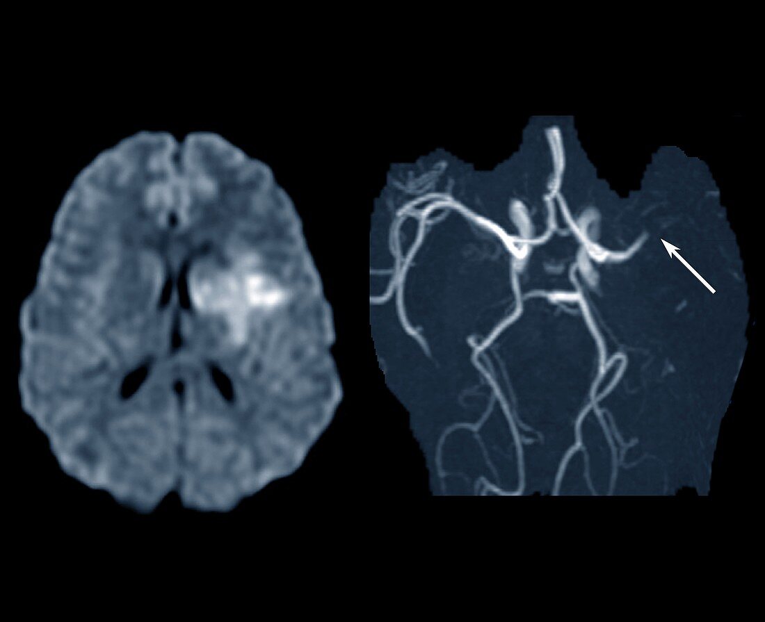 Stroke caused by a thrombosis, MRI and MRA scans