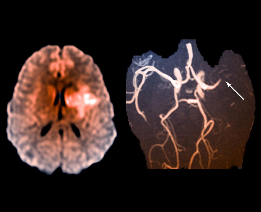 Stroke caused by a thrombosis, MRI and MRA scans