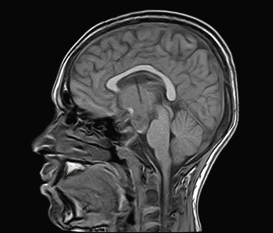 Cancer-induced hydrocephalus treatment, MRI scan