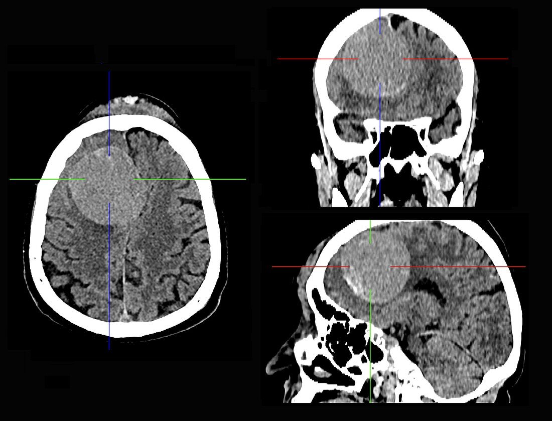 Meningioma brain cancer, CT scans