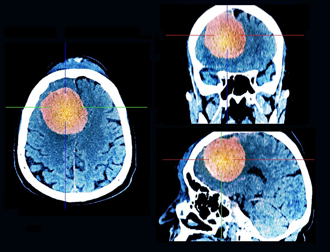 Meningioma brain cancer, CT scans