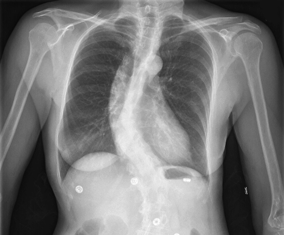 Scoliosis, X-ray