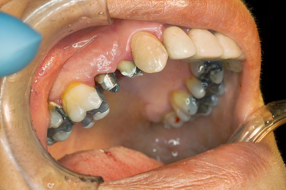 Dental post surgery