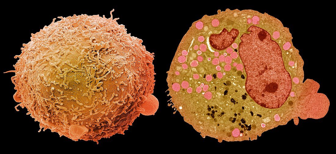 Carcinoma cell, SEM-TEM comparison