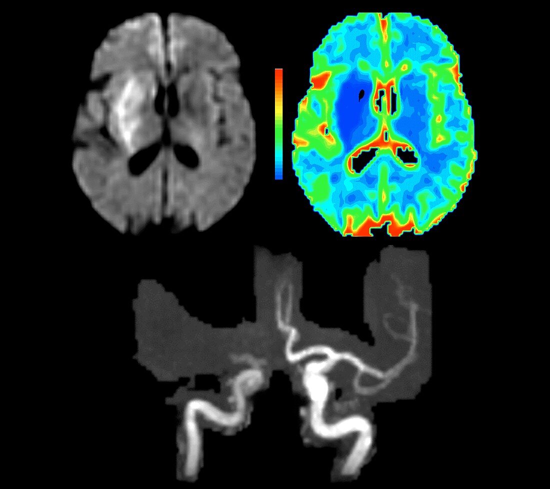 Brain damage due to a stroke, MRI scans