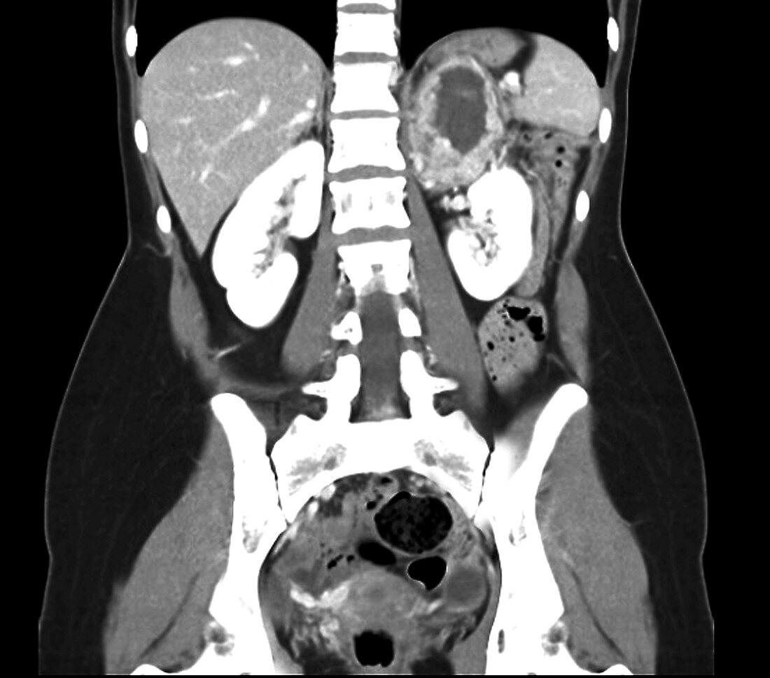 Adrenal gland cancer, CT scan