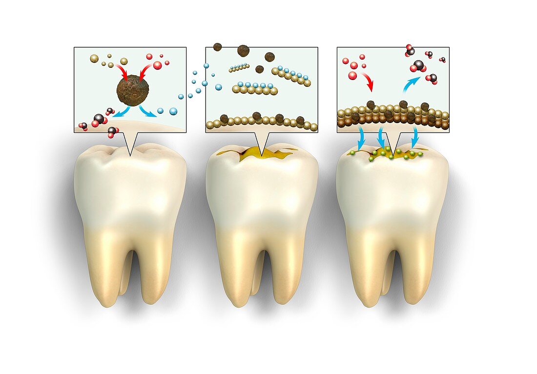 Formation of plaque on teeth, illustration