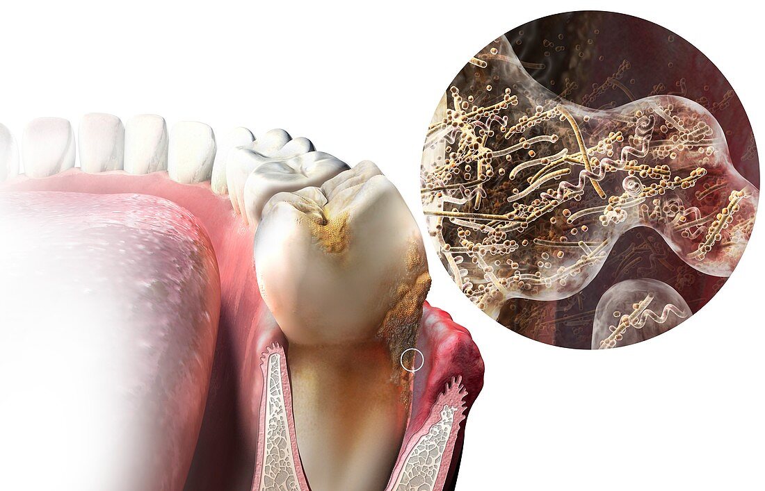 Plaque formation on teeth, illustration