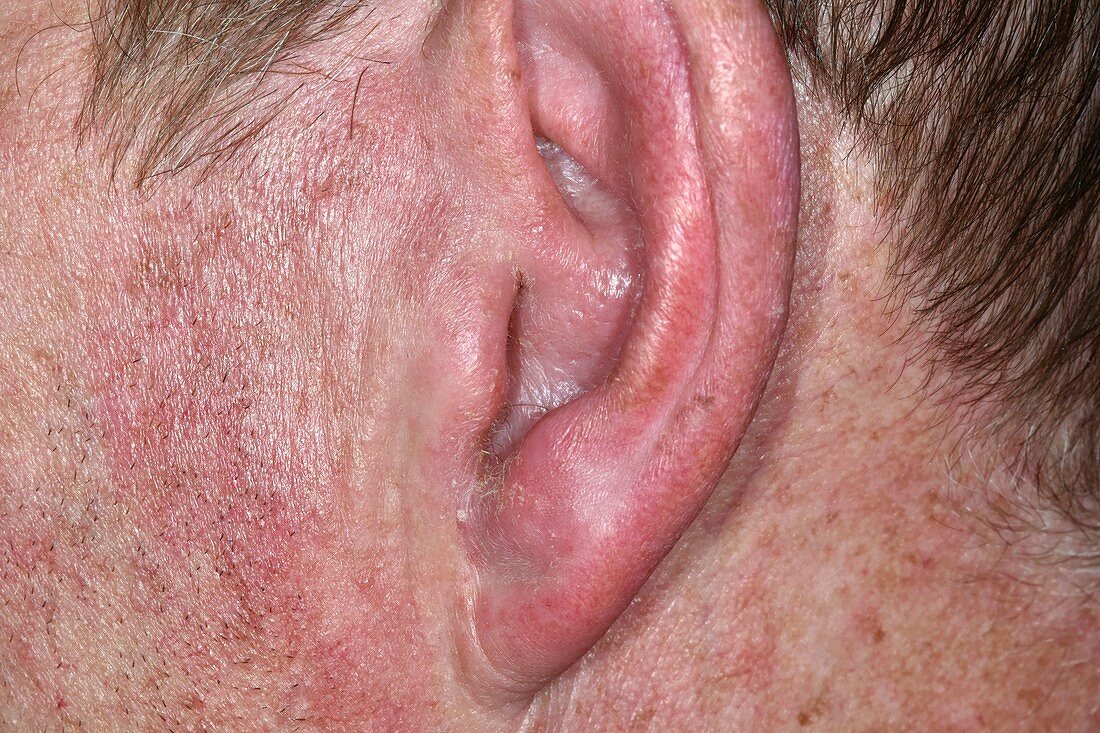 Outer ear infection