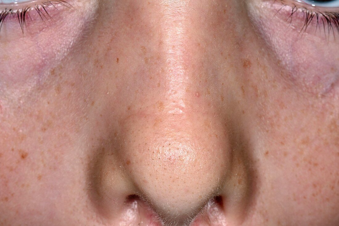 Allergic crease on nose in hay fever