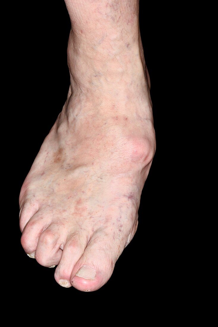 Foot in severe osteoarthritis