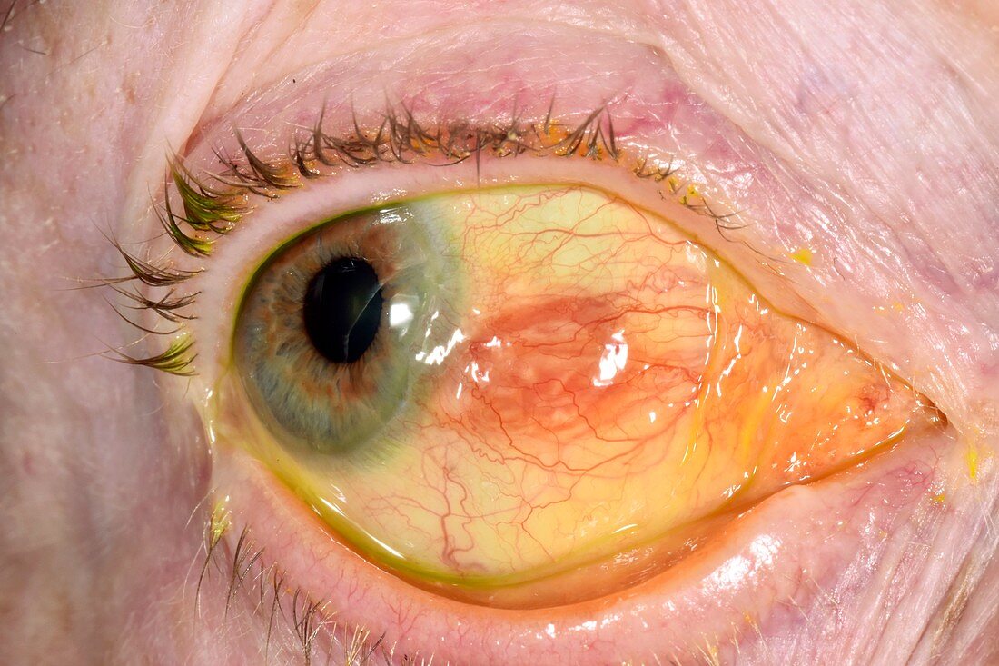 Conjunctival cyst treatment