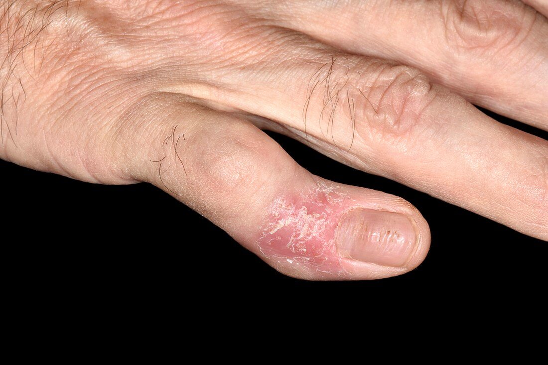 Psoriatic arthritis of the hands