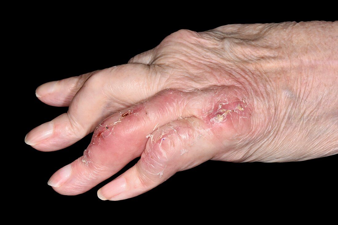 Hand in rheumatoid arthritis after surgery