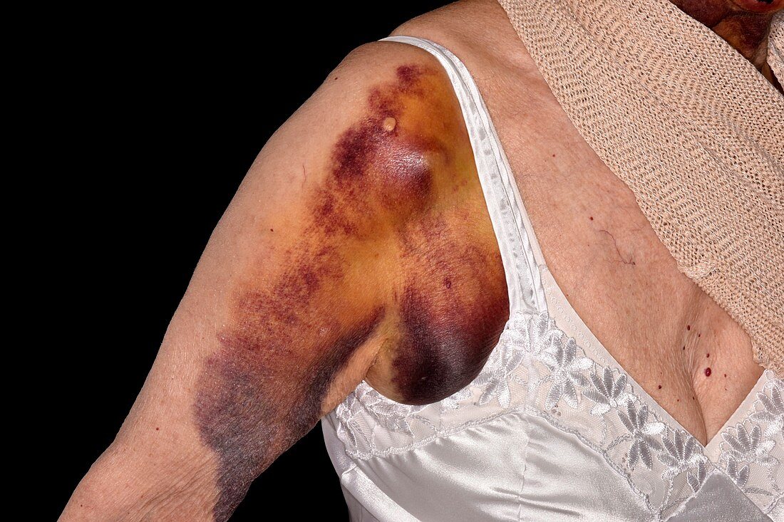 Bruises on warfarin patient's shoulder